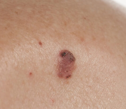 MELANOMUL MALIGN, INCIDENŢĂ ÎN CONTINUĂ CREŞTERE