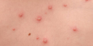 Focare de varicelă în școlile din Olt
