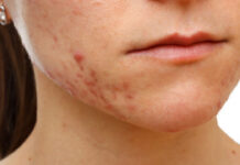 LEGĂTURA DINTRE ALIMENTAŢIE ŞI ACNEE