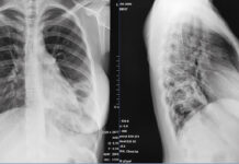 CAZ DE TBC LA MINULESCU