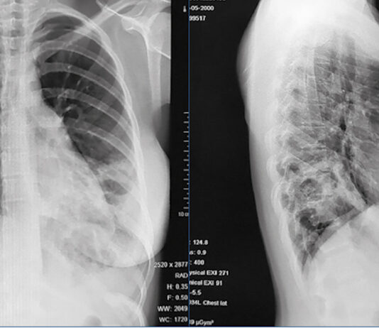 CAZ DE TBC LA MINULESCU