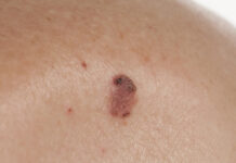 MELANOMUL MALIGN, INCIDENŢĂ ÎN CONTINUĂ CREŞTERE