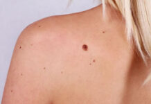 MELANOMUL NU ȚINE CONT DE VÂRSTĂ! TESTEAZĂ ALUNIȚELE!