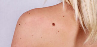 MELANOMUL NU ȚINE CONT DE VÂRSTĂ! TESTEAZĂ ALUNIȚELE!