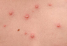 Focare de varicelă în școlile din Olt