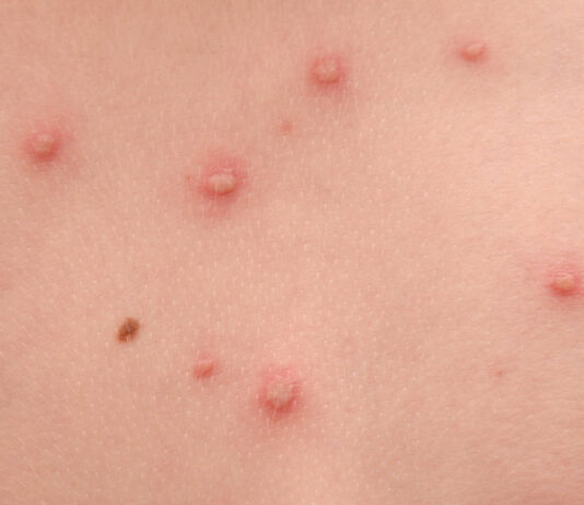 Focare de varicelă în școlile din Olt